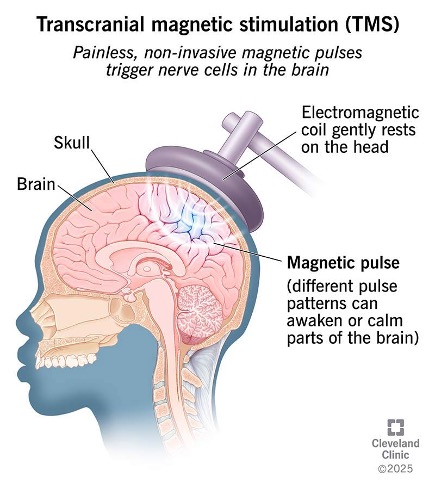 Diagram of transcranial magnetic stimulation: a magnetic coil rests on the head and sends painless pulses to nerve cells in the brain